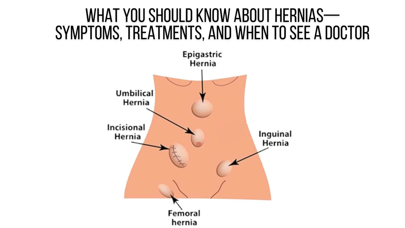 What You Should Know About Hernias—Symptoms, Treatments, and When to See a Doctor